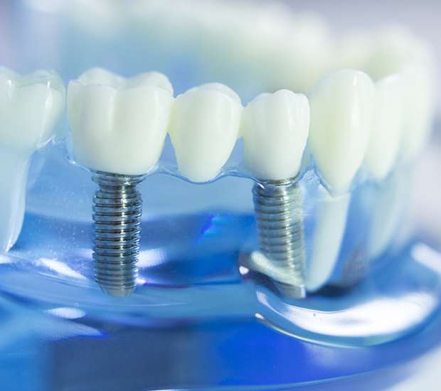 Laurel Springs Dental Implants